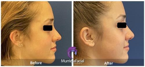 rhinoplasty murrieta before and after