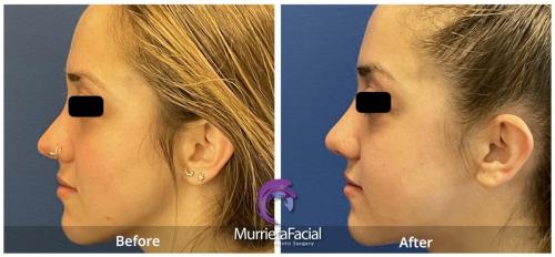 rhinoplasty murrieta before and after