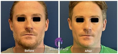 rhinoplasty murrieta before and after male