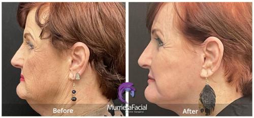 Facelift and Laser