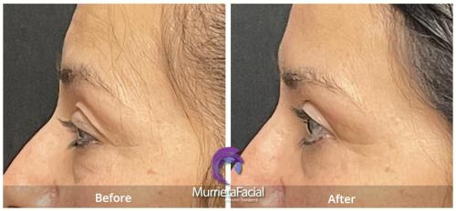 before-after-murietta-Blepharoplasty-female-