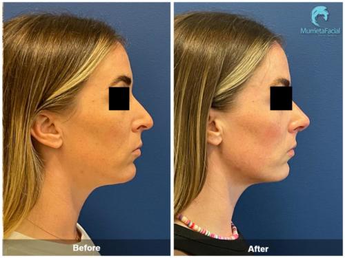 before-after-murietta-rhinoplasty-female-02